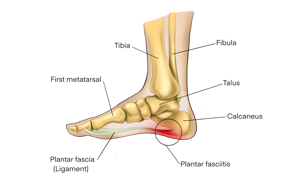 পায়ের গোড়ালিতে ব্যথা বা প্লান্টার ফ্যাসাইটিস থেকে পরিত্রাণের উপায় কী?