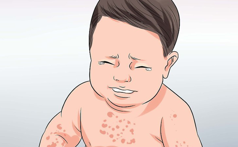 বাচ্চাদের হিট র‍্যাশ | এটি থেকে মুক্তি পেতে ৬টি হোম রিমেডি