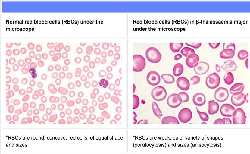 থ্যালাসেমিয়া | কারণ, লক্ষণ ও প্রতিকার জানা আছে কী?