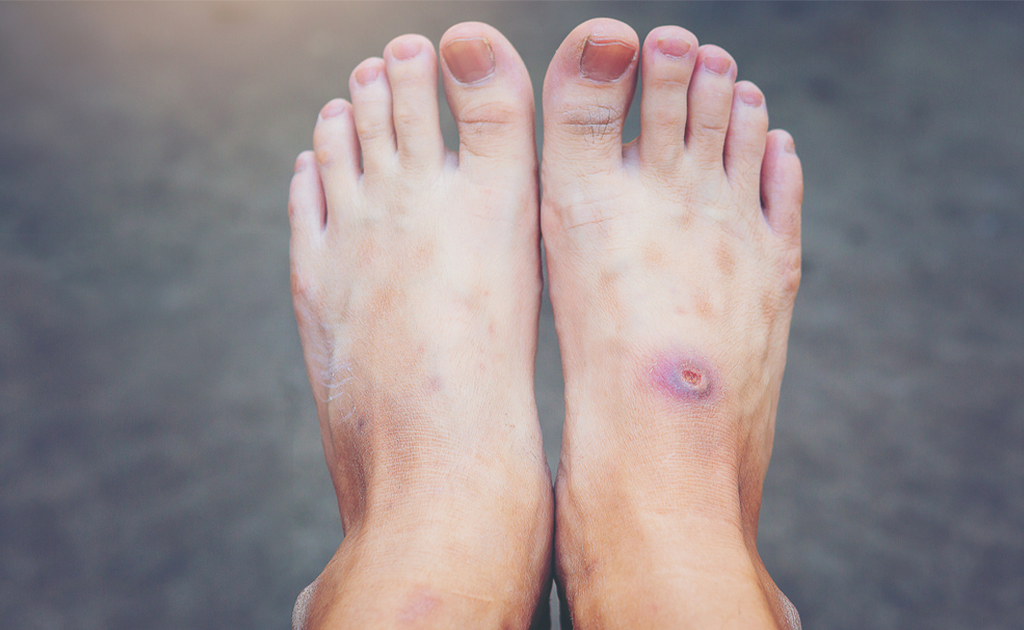 ডায়াবেটিক নিউরোপ্যাথি বা স্নায়ুর সমস্যার উপসর্গ, করণীয় ও চিকিৎসা