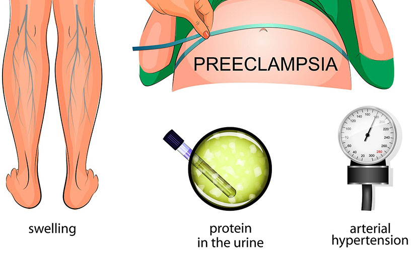 গর্ভকালীন উচ্চ রক্তচাপ নিয়ে কতটা জানেন?