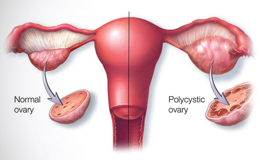 বন্ধ্যাত্ব | কারণ ও চিকিৎসা কি?